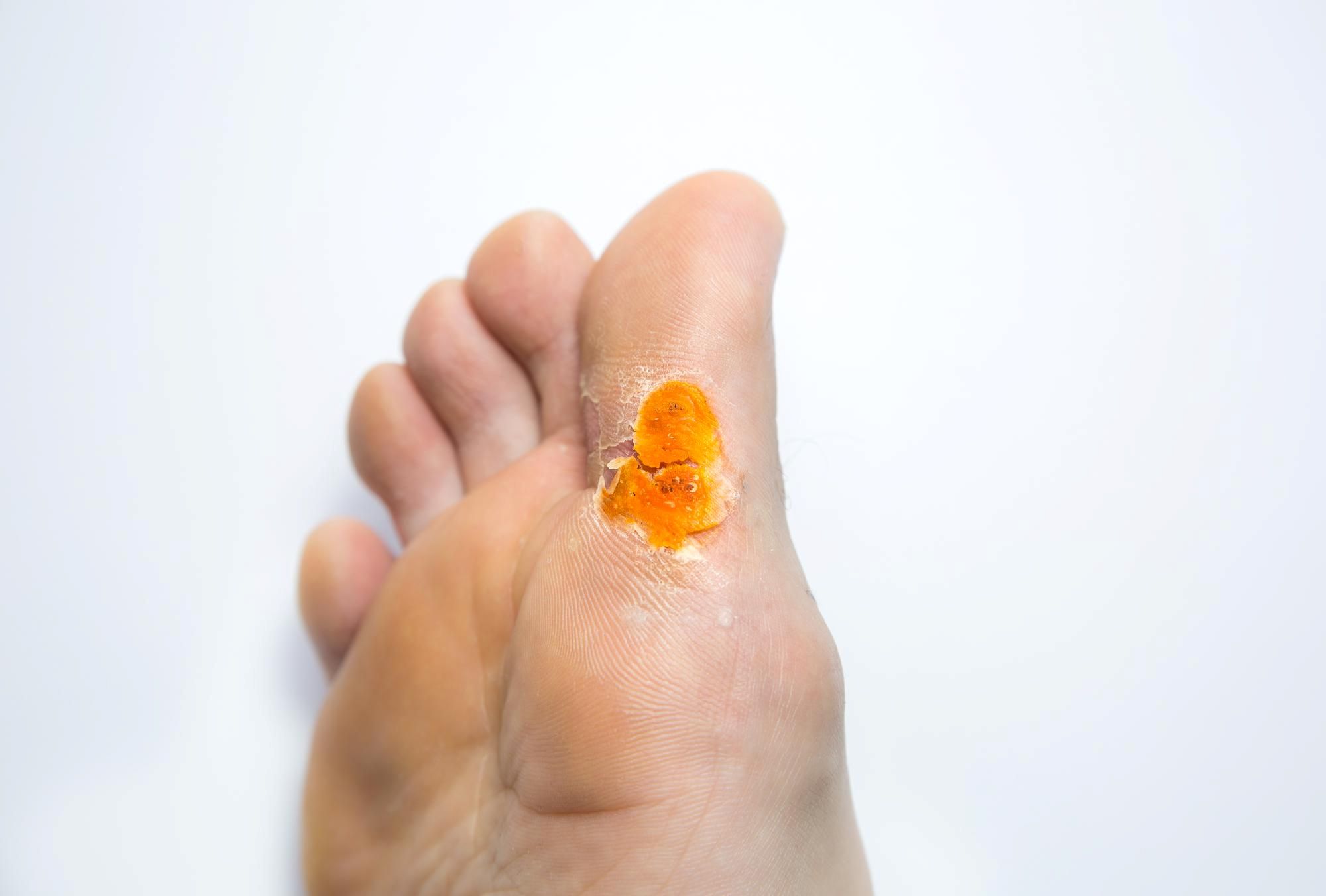 Foot Joint Infection Causes Symptoms Treatment Options