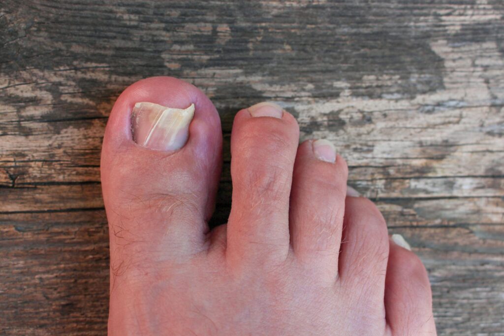 Toenail Solutions